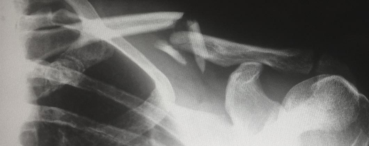 X-ray-broken-bones